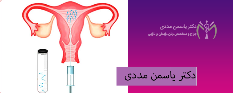 درصد موفقیت روش iui