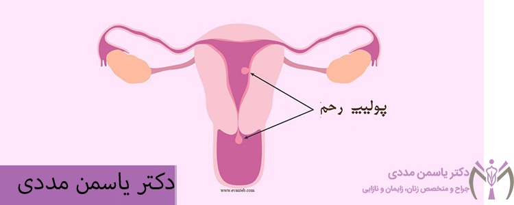 درمان پولیپ رحم در رشت