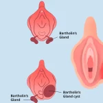علائم کیست بارتولن