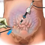 مزایای لاپاراسکوپی رحم و تخمدان